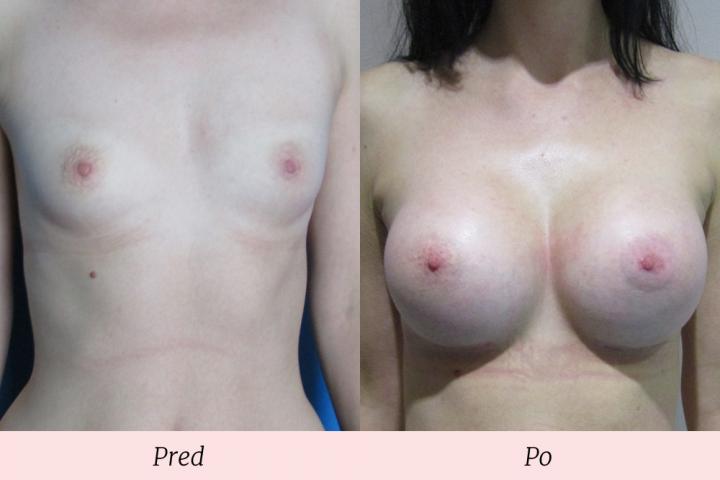 Galéria Zväčšenie prsníkov - pred a po zákroku