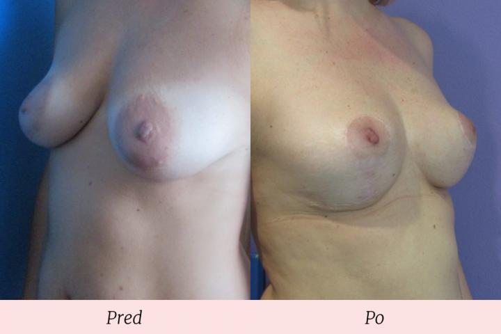 Galéria Modelácia prsníkov - pred a po zákroku