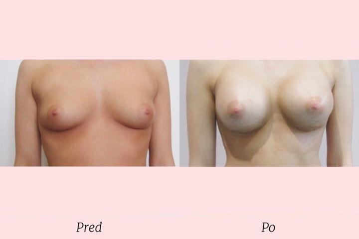 Galéria Zväčšenie prsníkov - pred a po zákroku