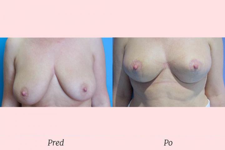 Galéria Modelácia prsníkov - pred a po zákroku