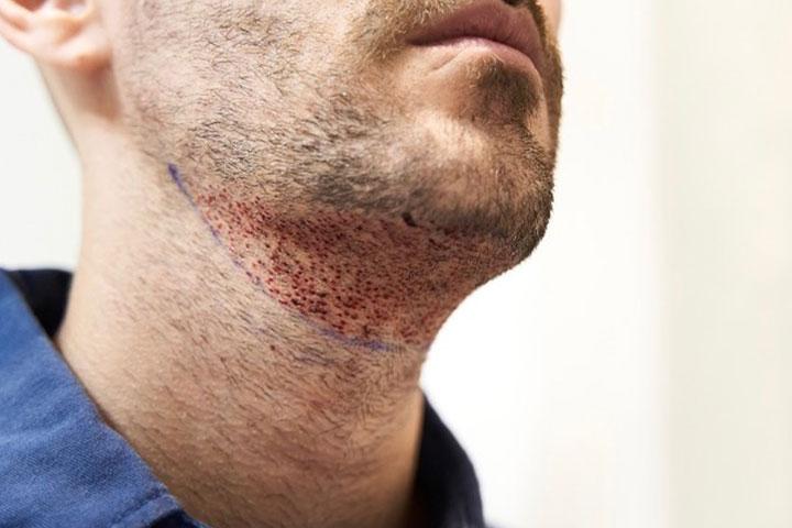 FUE Transplantácia brady