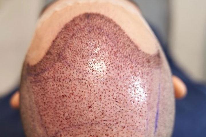 FUT Transplantácia vlasov