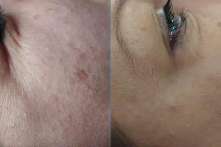 Dermatohelióza, žena. 1 procedúra.