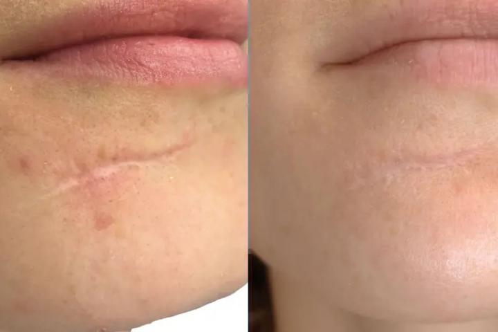 Vyhladenie jazvy na brade, 31-ročná žena. 2 procedúry.