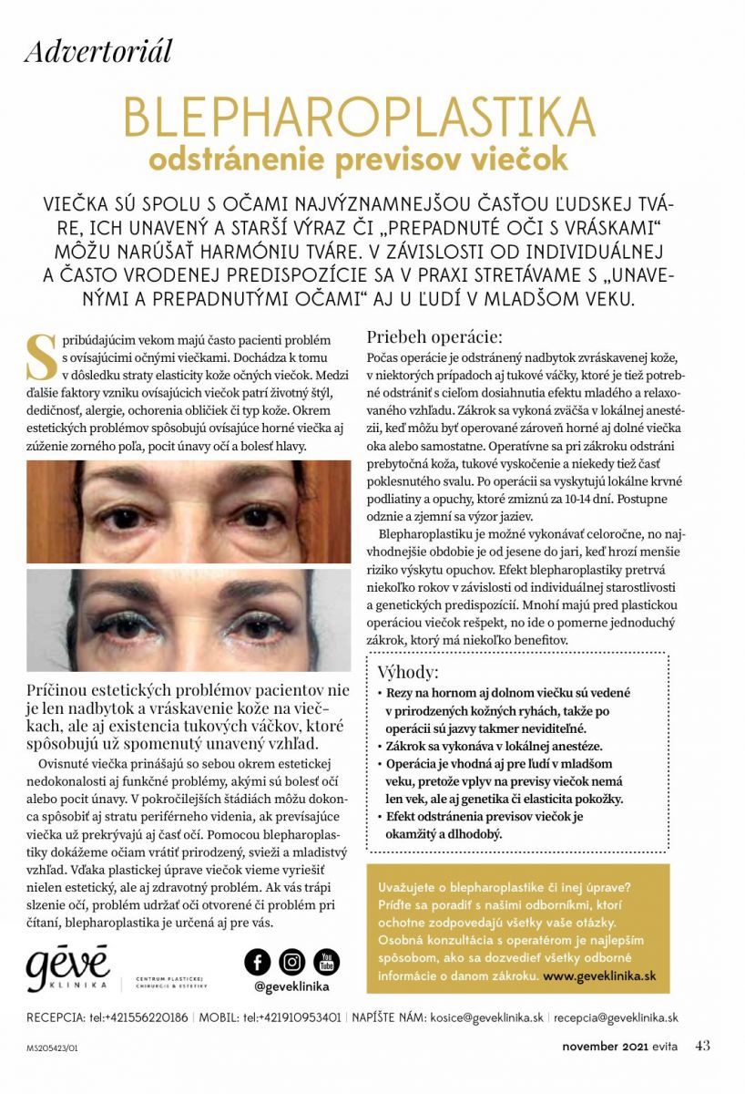 Blepharoplastika