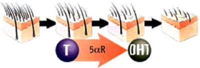 Zmenšovanie vlasových folikulov vplyvom DHT