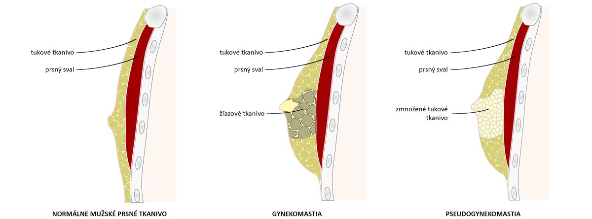 Gynekomastia