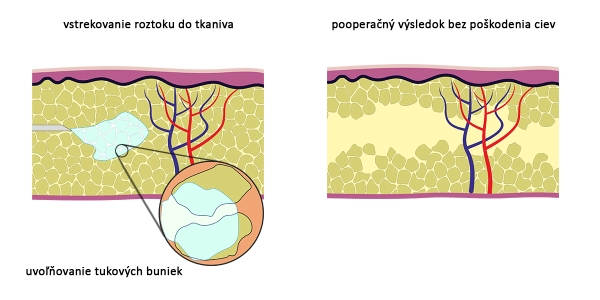 Liposukcia Water-Jet
