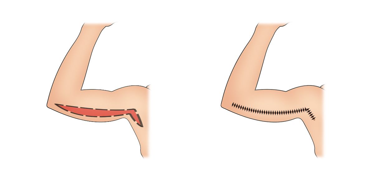 Odstránenie nadbytočnej kože a tuku z ramien 