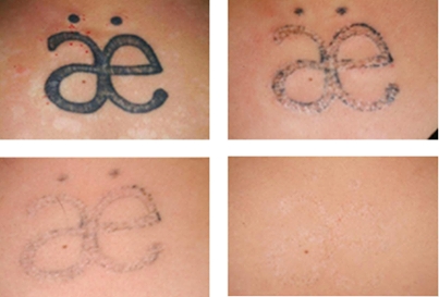 Laserové odstraňovanie tetovania